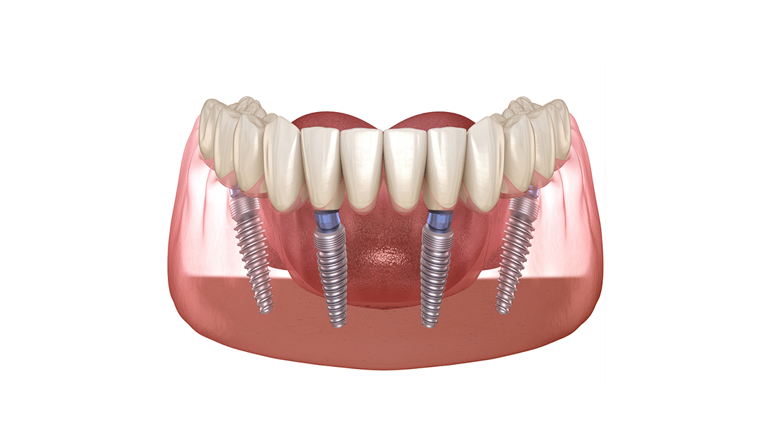 Full Arch Implant photo