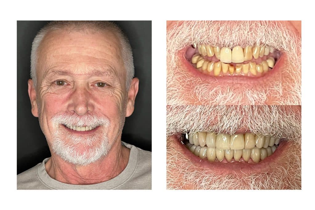 Redefining Health and Confidence With a Smile Transformation